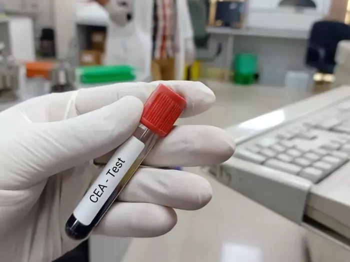 carcino embryonic antigen test 